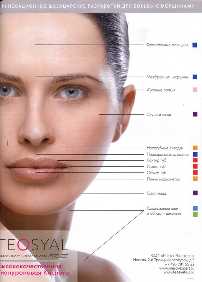 Линии ниже глаз. Зоны лица в косметологии. Схема введения ботокса на лице. Зоны введения филлеров на лице. Зоны для ботокса на лице.